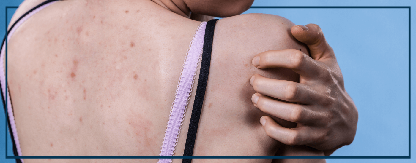 Bacne? More common than you think!