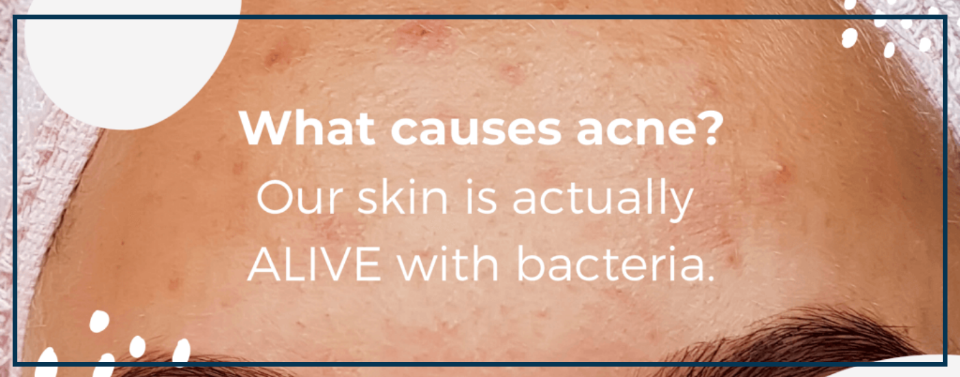 LUSTRE ClearSkin, acne causes, blog