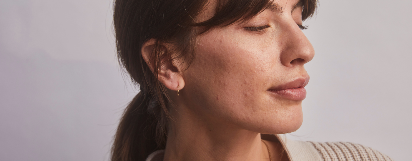 What do blue & red LED lights actually do for acne?