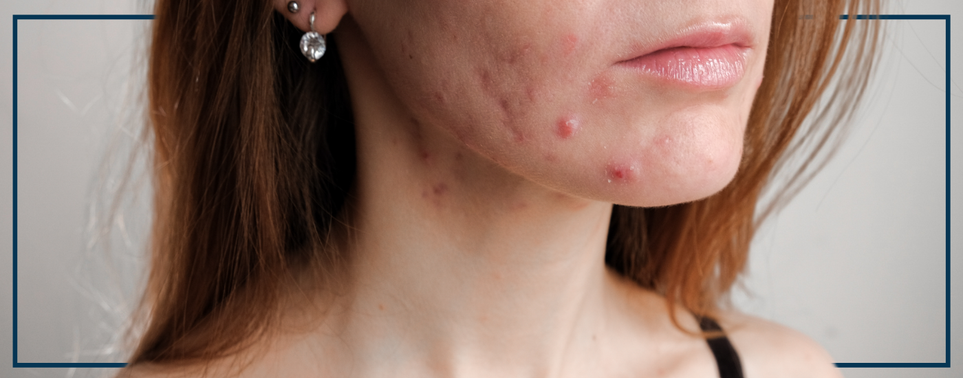 LUSTRE ClearSkin, Acne Treatment, Blue Light Therapy