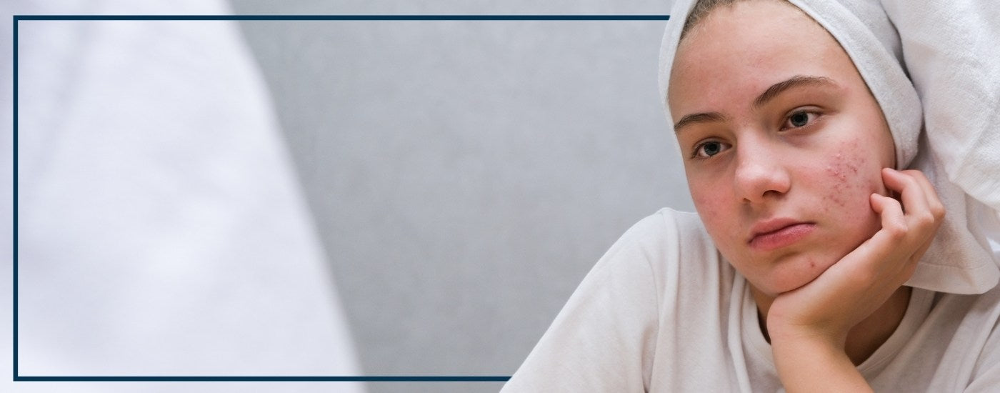 Acne and Stress Management