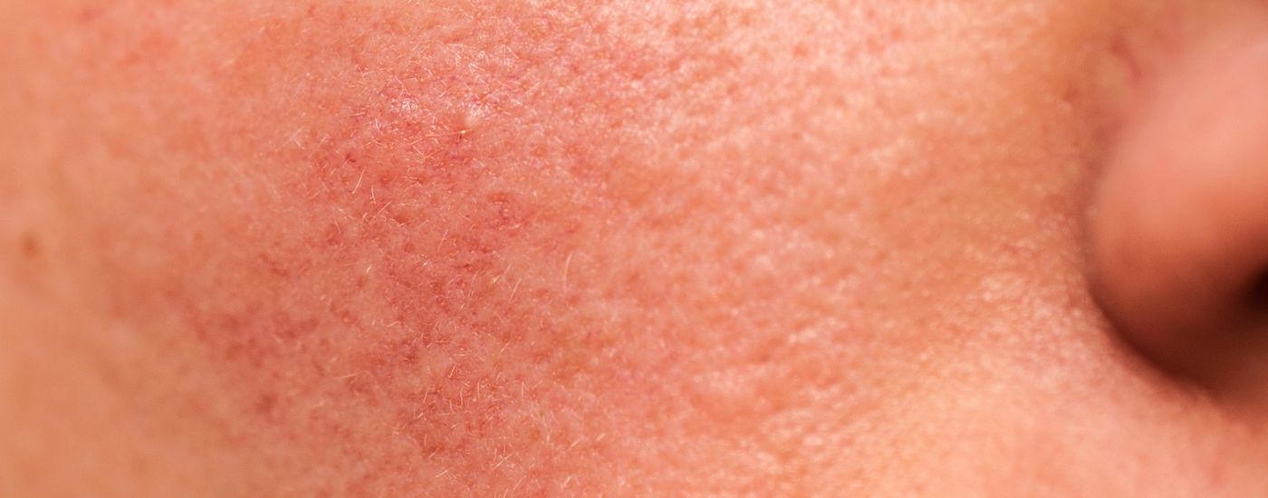 Rosacea
