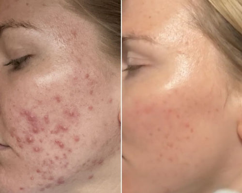 before and after thumb