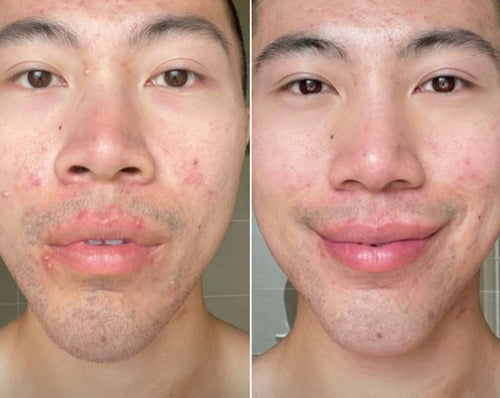 before and after thumb