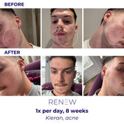 LUSTRE® ClearSkin RENEW PRO FACEWEAR